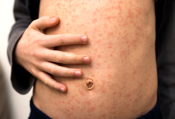 What You Need to Know about Measles in 2024