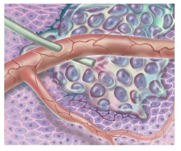 IV fluid infiltration