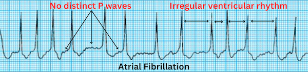 Atrial-Fibrillation_1.png
