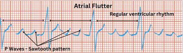 Atrial-Flutter.png