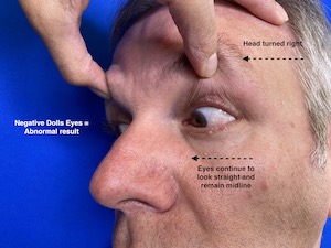 How to evaluate a doll’s eye reflex - Sentinel Nurse