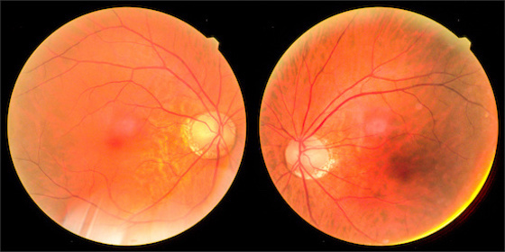 abnormal retina