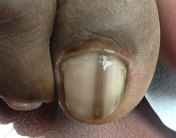 A Review Of Nail Dystrophies For The Practitioner Ce Article Nursingcenter